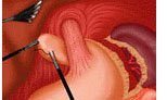 Fundoplication Surgery